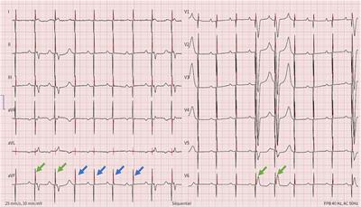 Case Report: A leadless and endovascular pacemaker teamwork